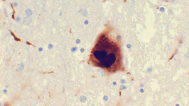 تحقیقات سلامت روده را به بیماری های تحلیل برنده عصبی مرتبط کرد!