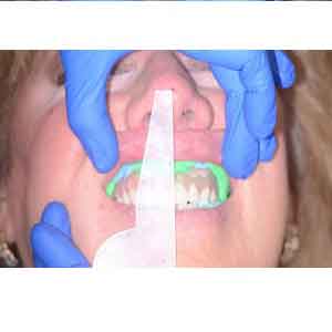 بلاگ تاثیر دو روش ریلاین مستقیم و غیر مستقیم در دقت ابعادی سد کامی-خلفی